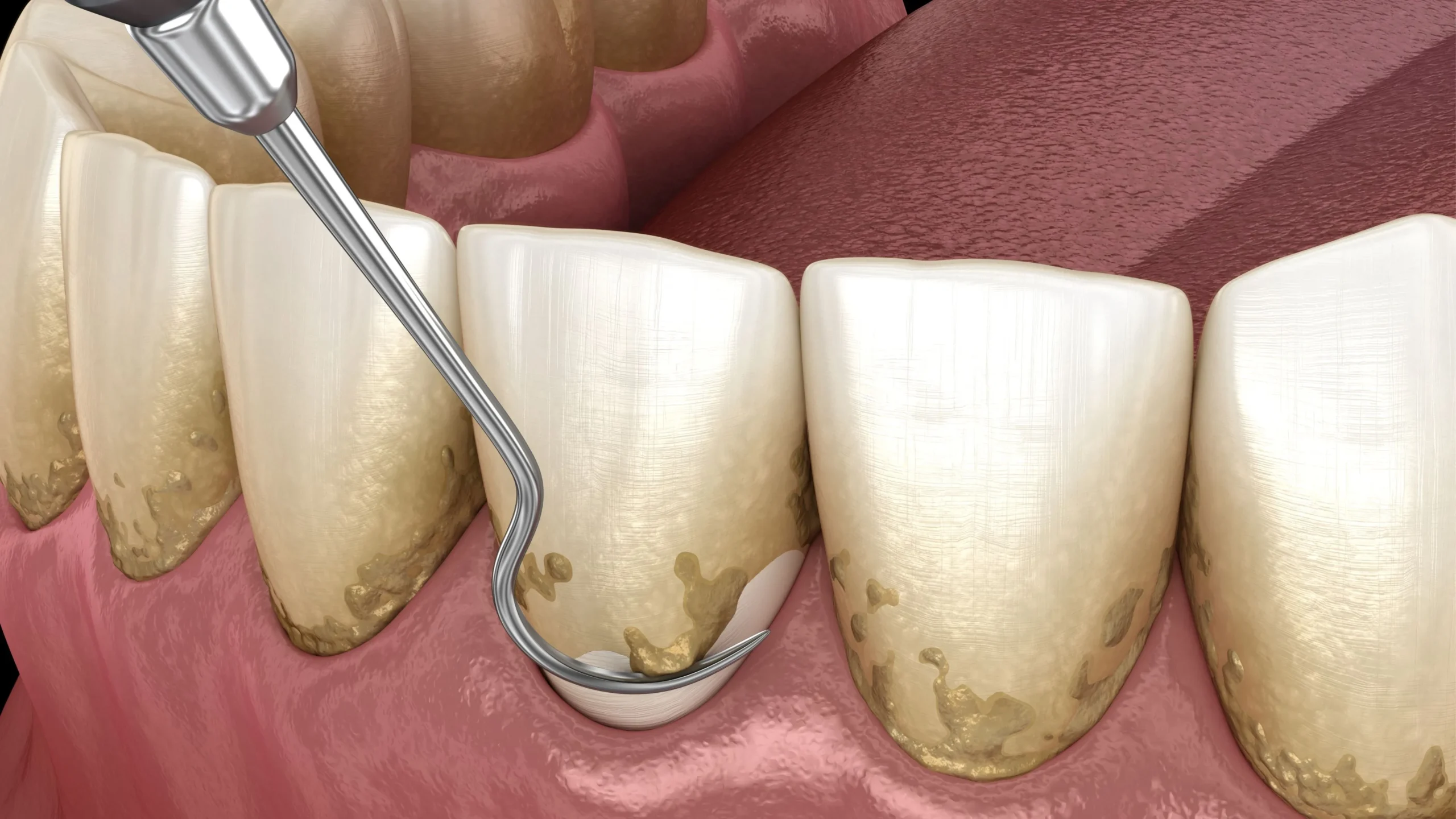 Parodontite acuta: cause, sintomi e rimedi - Polimedical Torino