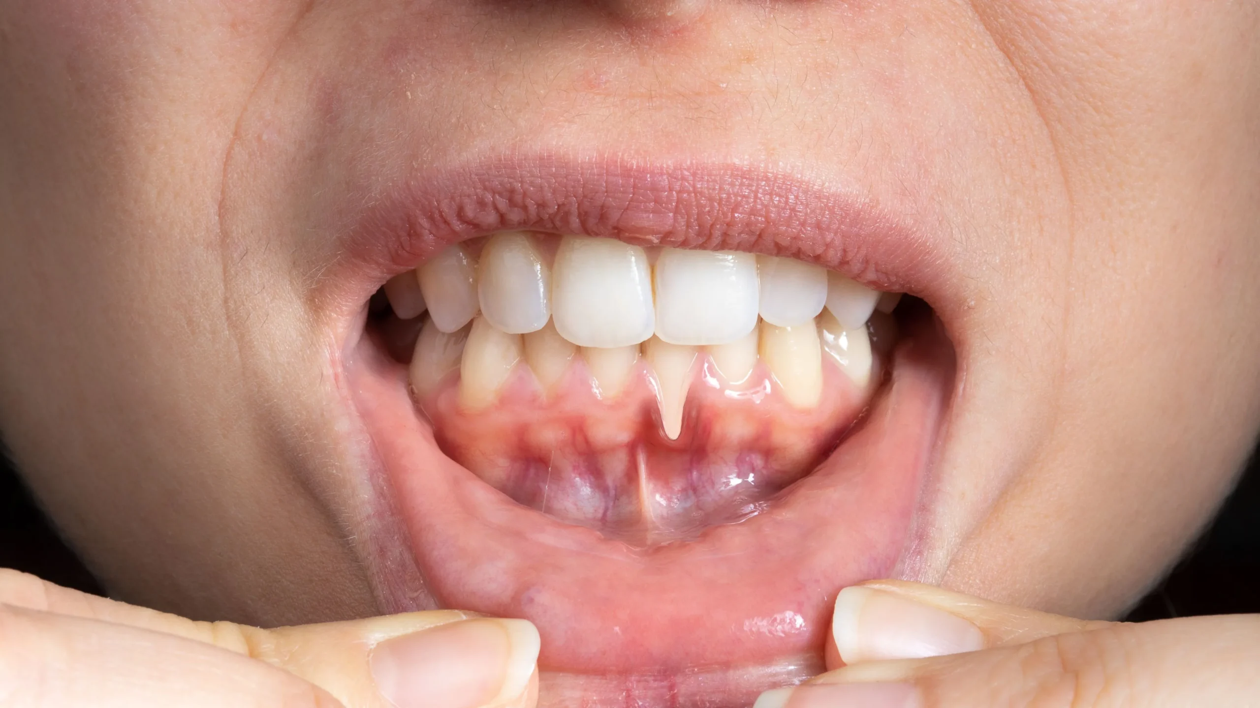 Parodontite acuta: cause, sintomi e rimedi - Polimedical Torino