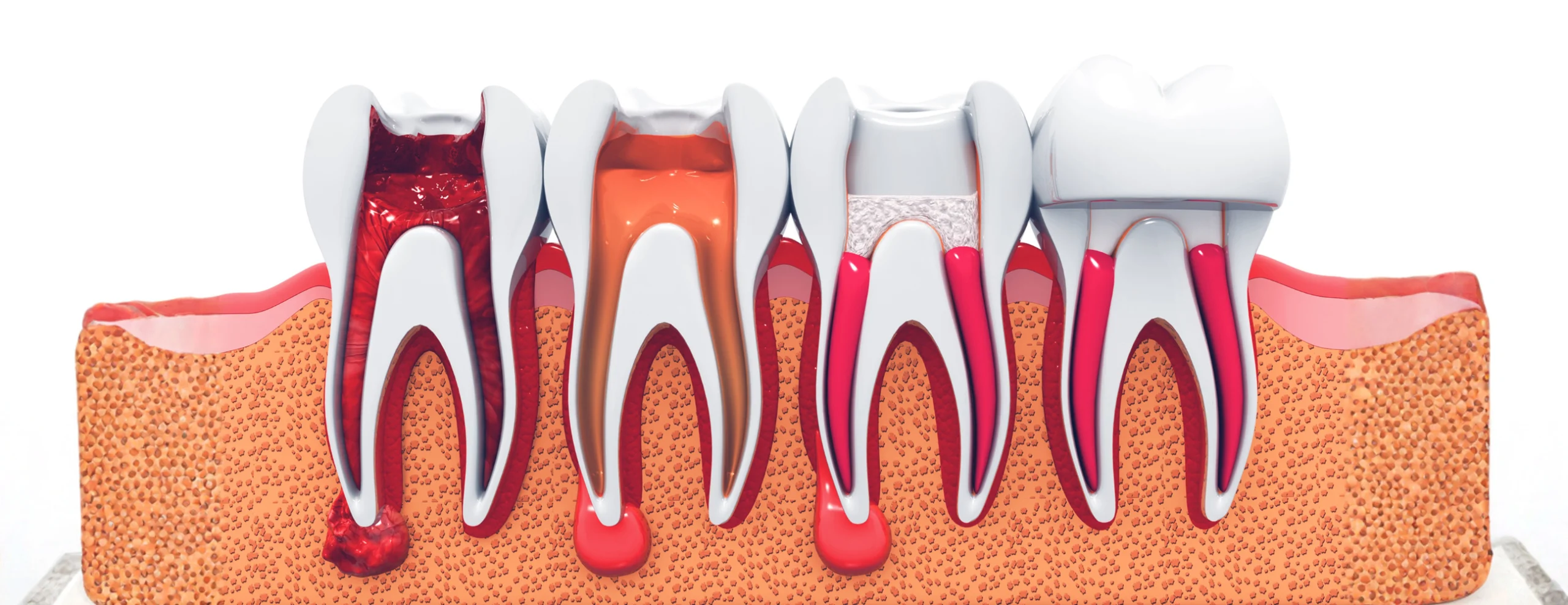 Pulpite Dentale: cause, sintomi e rimedi - Polimedical Torino - Dentista Torino