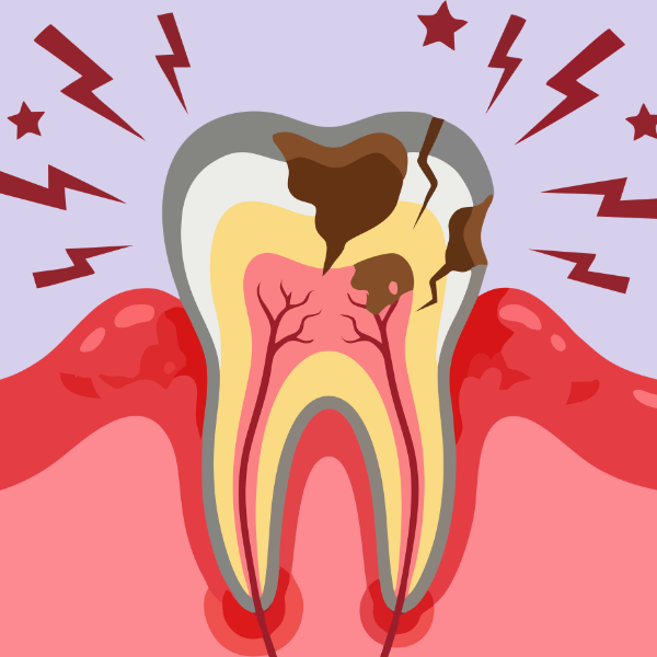 Pulpite Dentale: cause, sintomi e rimedi