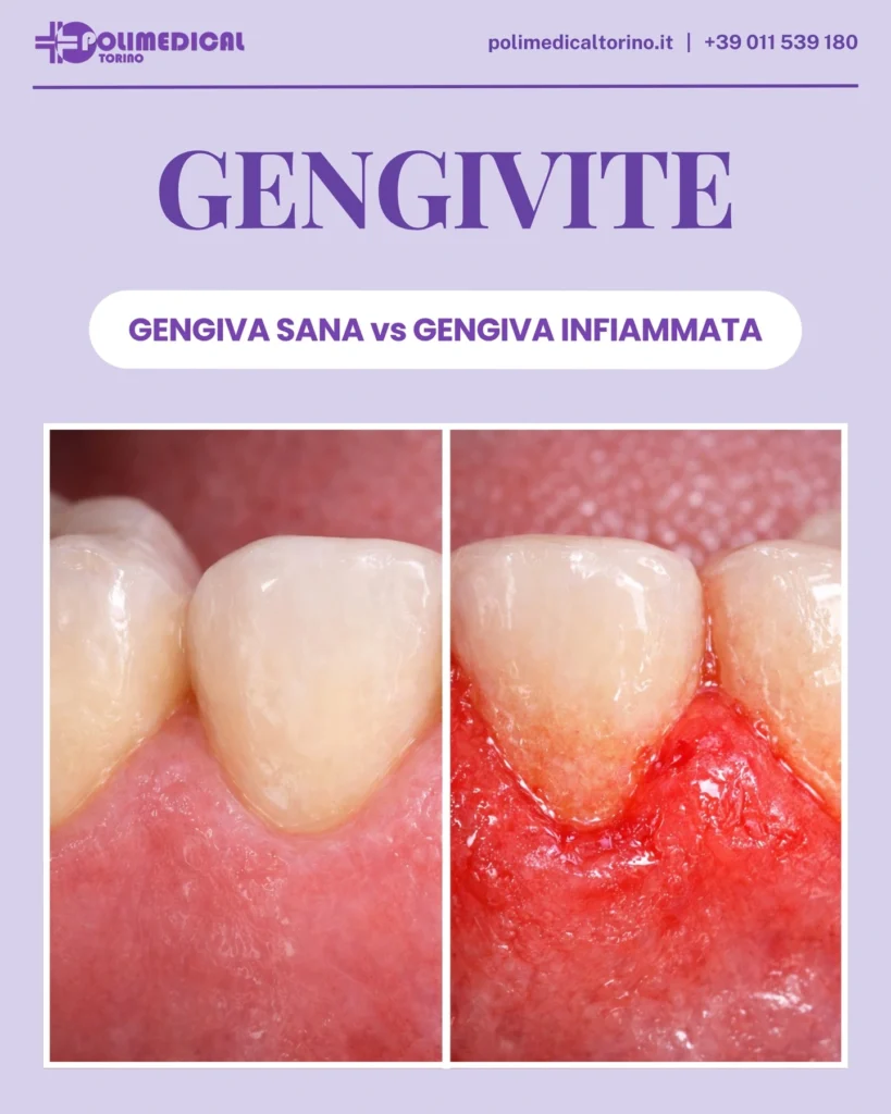 Gengivite: cause, sintomi e rimedi - polimedical torino
