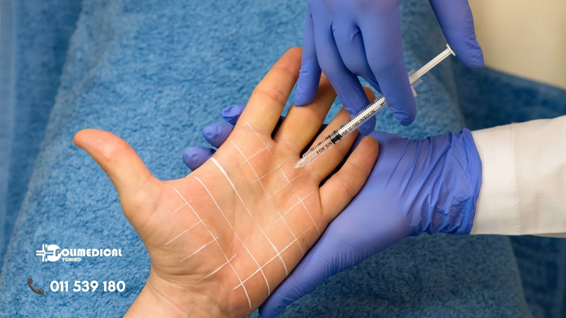 Sudore alle mani - iperidrosi palmare - Polimedical Torino