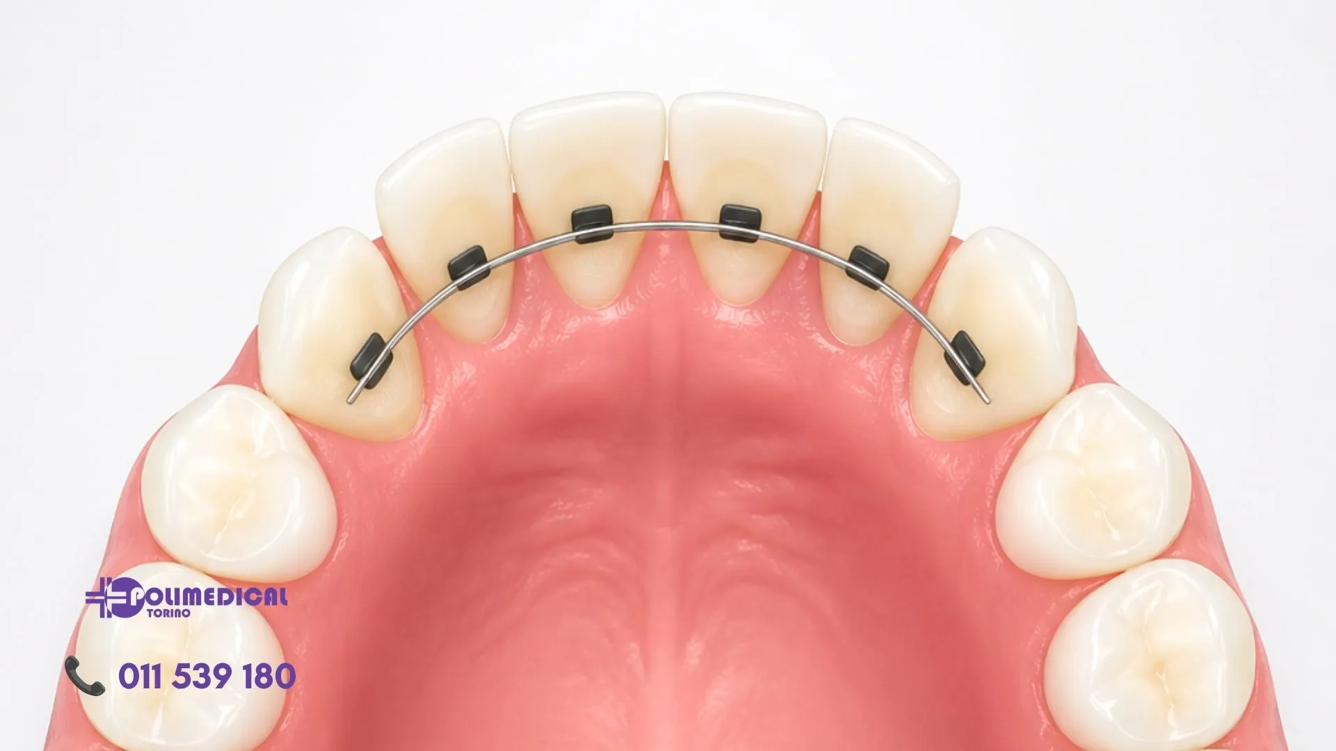 Perché i denti si spostano dopo l’apparecchio? Il ruolo della contenzione - polimedical torino