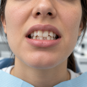 Perché i denti si spostano dopo l’apparecchio? Il ruolo della contenzione - polimedical torino