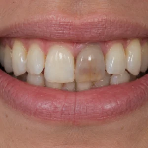 Perché un dente diventa nero? - Polimedical Torino - Dentista a Torino